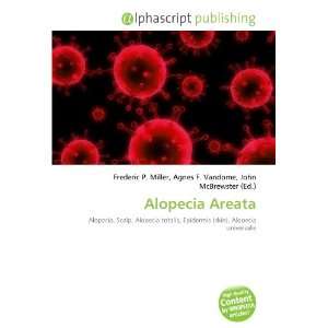  Alopecia Areata (9786134000130) Books